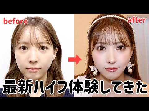 最新のハイフ体験したらすごすぎた。