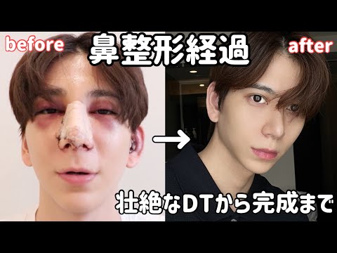 【整形】マネージャーかへみの壮絶な鼻整形ダウンタイム経過観察。