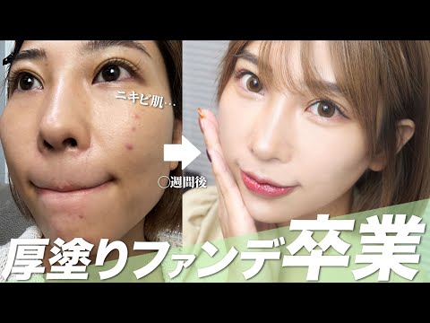 【ニキビ・肌荒れ】実際に試した肌質改善の最短方法全てお話します。